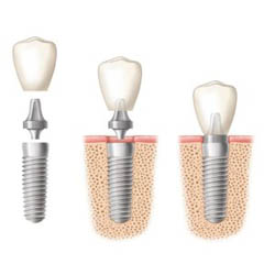 Dental Implant Cost Sydney