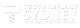 Tooth Implant Sydney