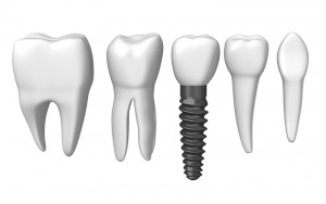 cost of dental implants in Sydney