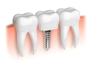 Cost of Dental Implants