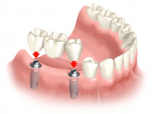 Dental Bridges versus Dental Implants