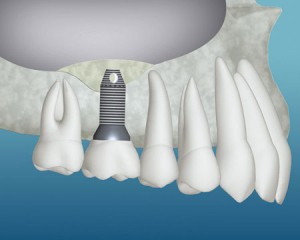 Trends in Implant Dentistry 