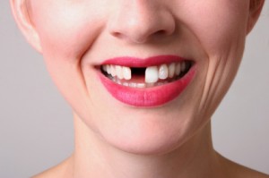 replace your missing teeth