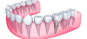 identify that you need prosthetic teeth