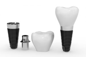 Dental Implanting Procedure