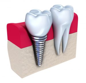 dental-implants-safer