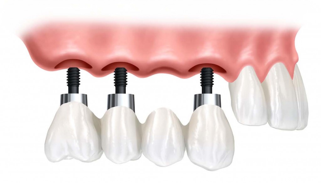 A brief overview on the history of Dental Implants Tooth Implant