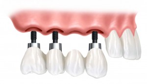 history of Dental Implants