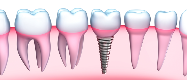 advancements-of-dental-implants