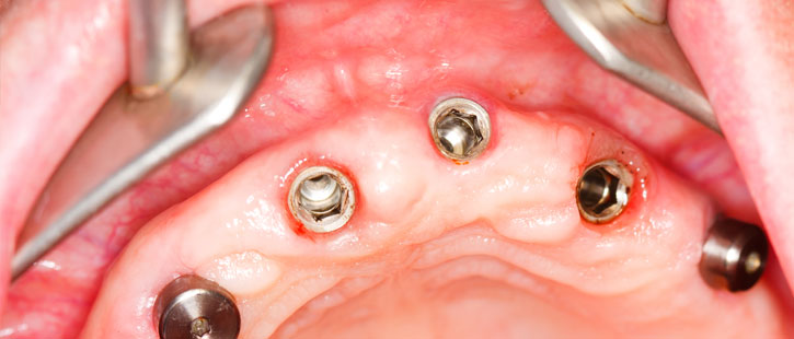 dental-implant-mistakes-to-avoid