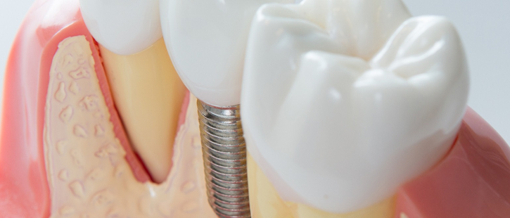 after-your-dental-implant-surgery