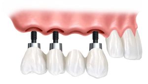 Dental Implants