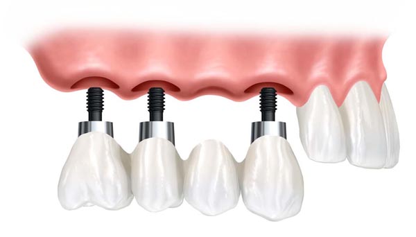 Dental Implants