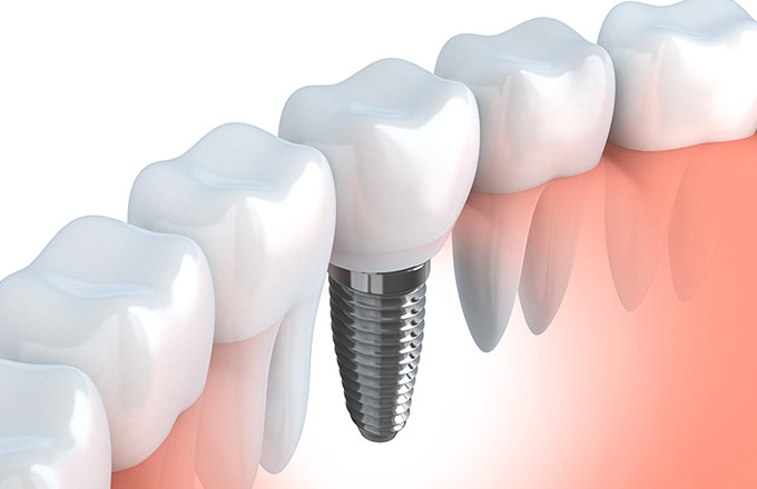 dental implants in Sydney