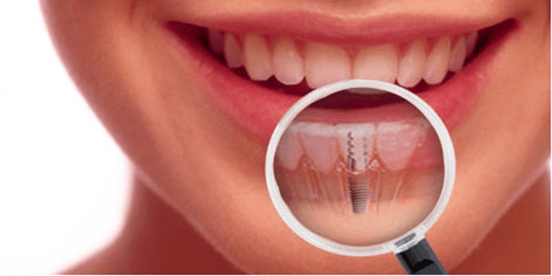dental implants cost in Sydney