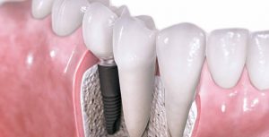 tooth implants Sydney