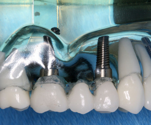 dental implants in Sydney