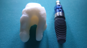 cost of dental implants