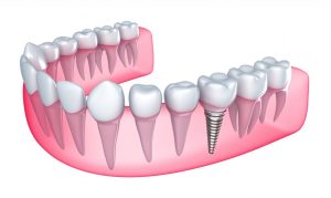 cost of dental implants in Sydney