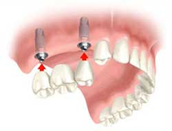 Goodness of Dental Implants