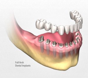 dental implants cost in Sydney