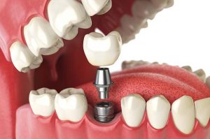 Sydney dental implants