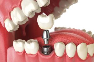 dental implant cost