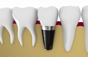 dental implants in Sydney