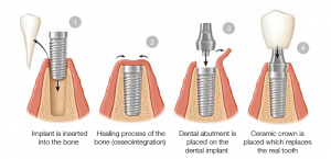 Dental Implant Process