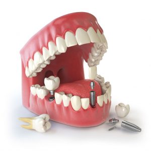 dental implants cost in Sydney