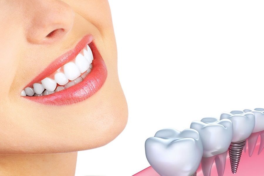 How Dental Implants Could Help Enhance Your Smile? - Tooth Implant