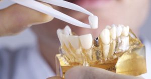 dental implants Sydney