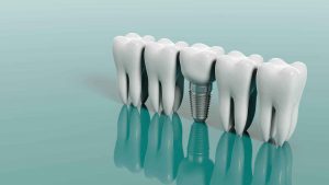 Dental Implant