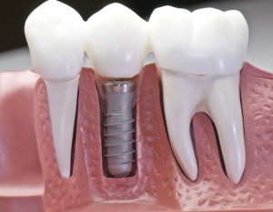 Dental Implants Sydney