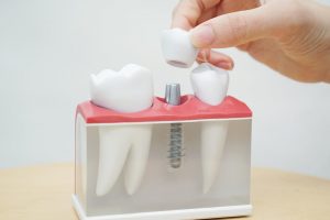 dental Implants