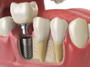 Dental Implant Procedure