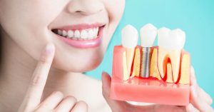 Dental Implants