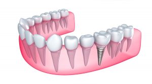 Dental Implants