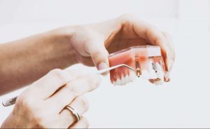 Benefits of Replacing Missing Teeth