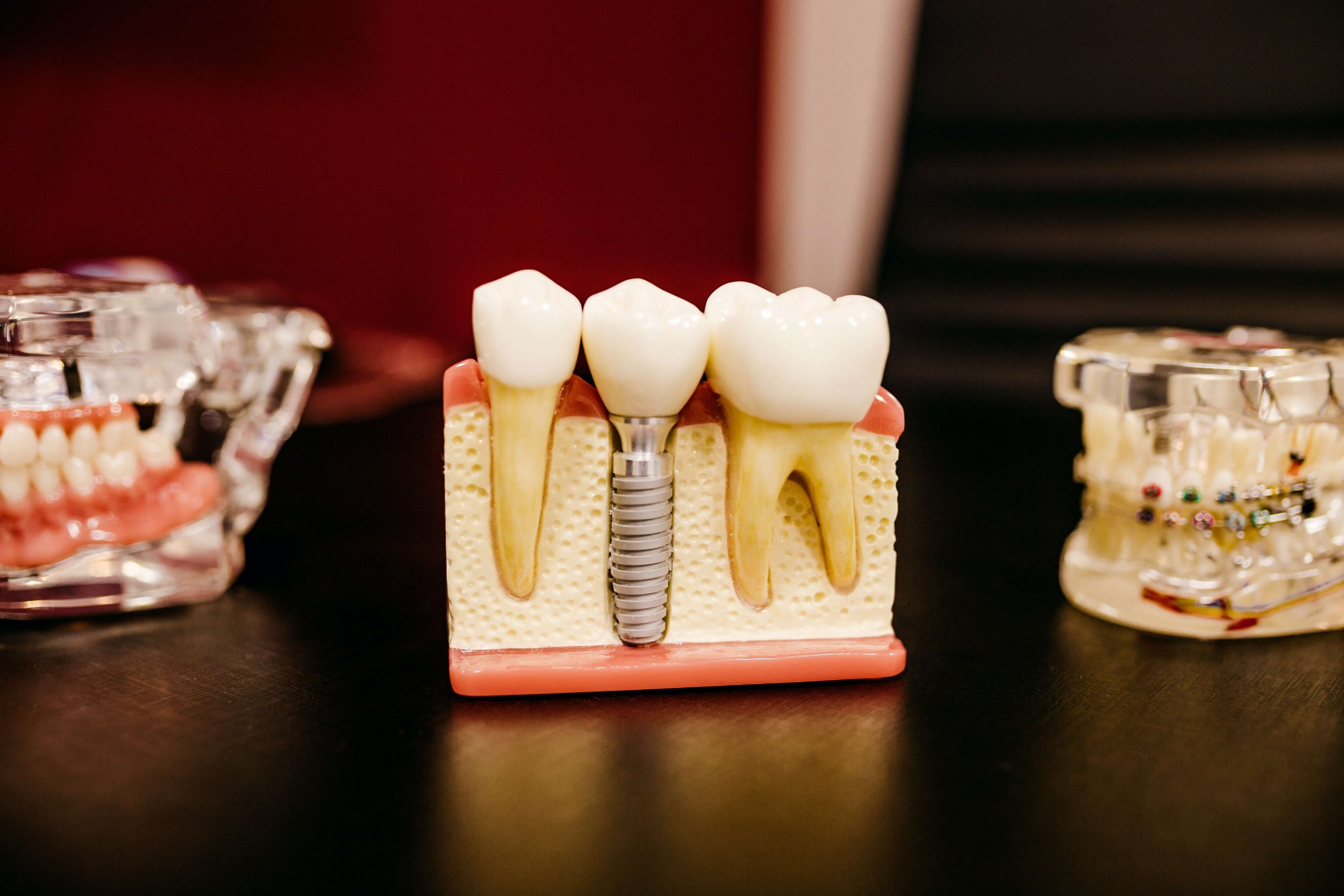 Dental Implants Common Questions Answered! Tooth Implant