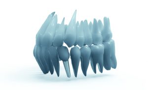 Benefits Of Having Dental Implant Without Any Delay