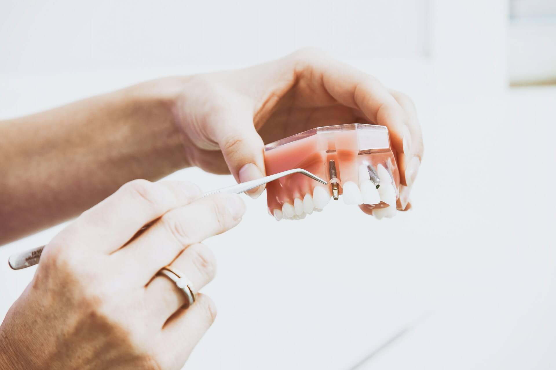Choosing the Right Dental ImplantSydney