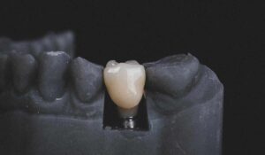 dental implant Sydney