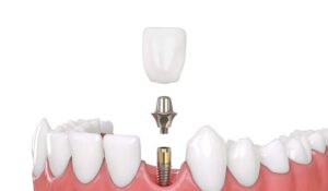 Dental implant in Sydney