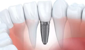 Dental implants price Sydney