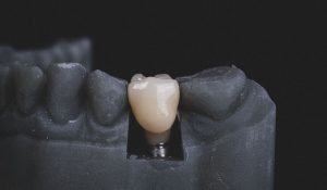 dental implants Sydney