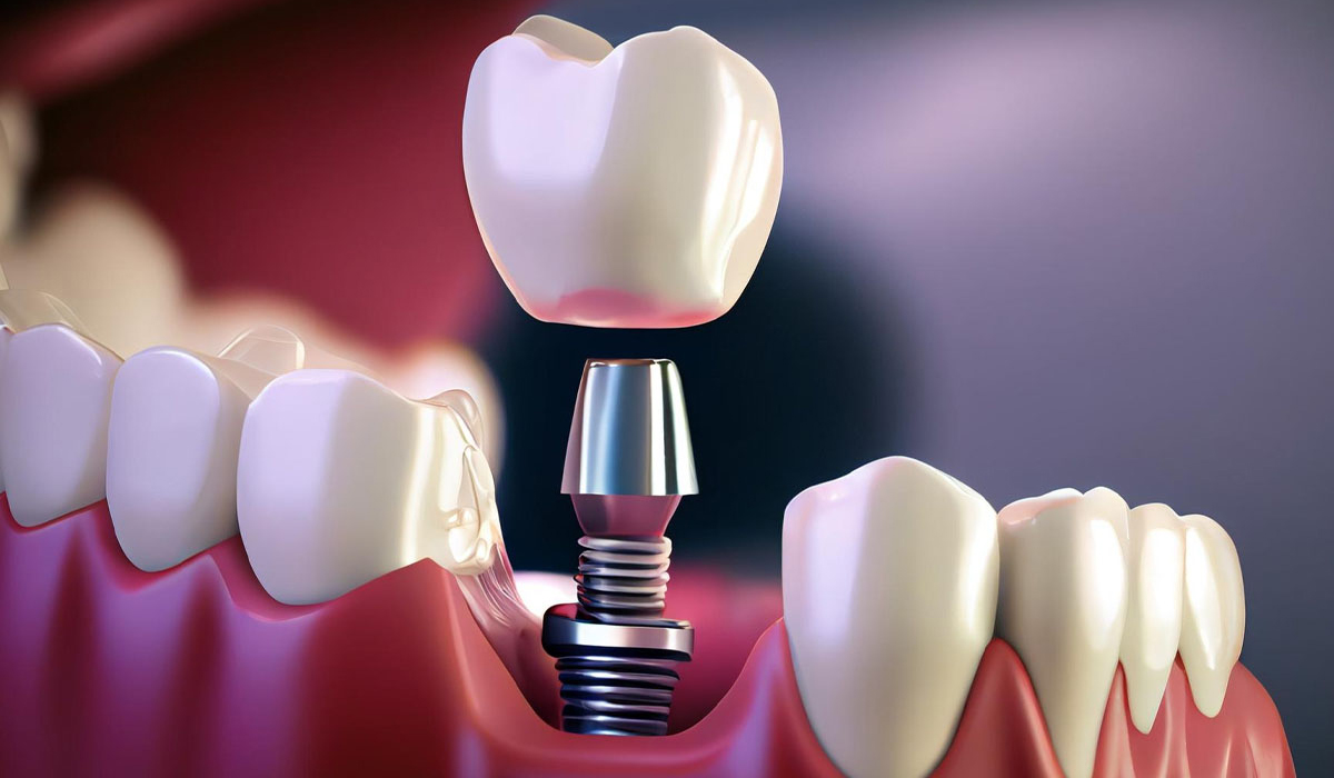 dental implants cost - dental implant professionals - sydney