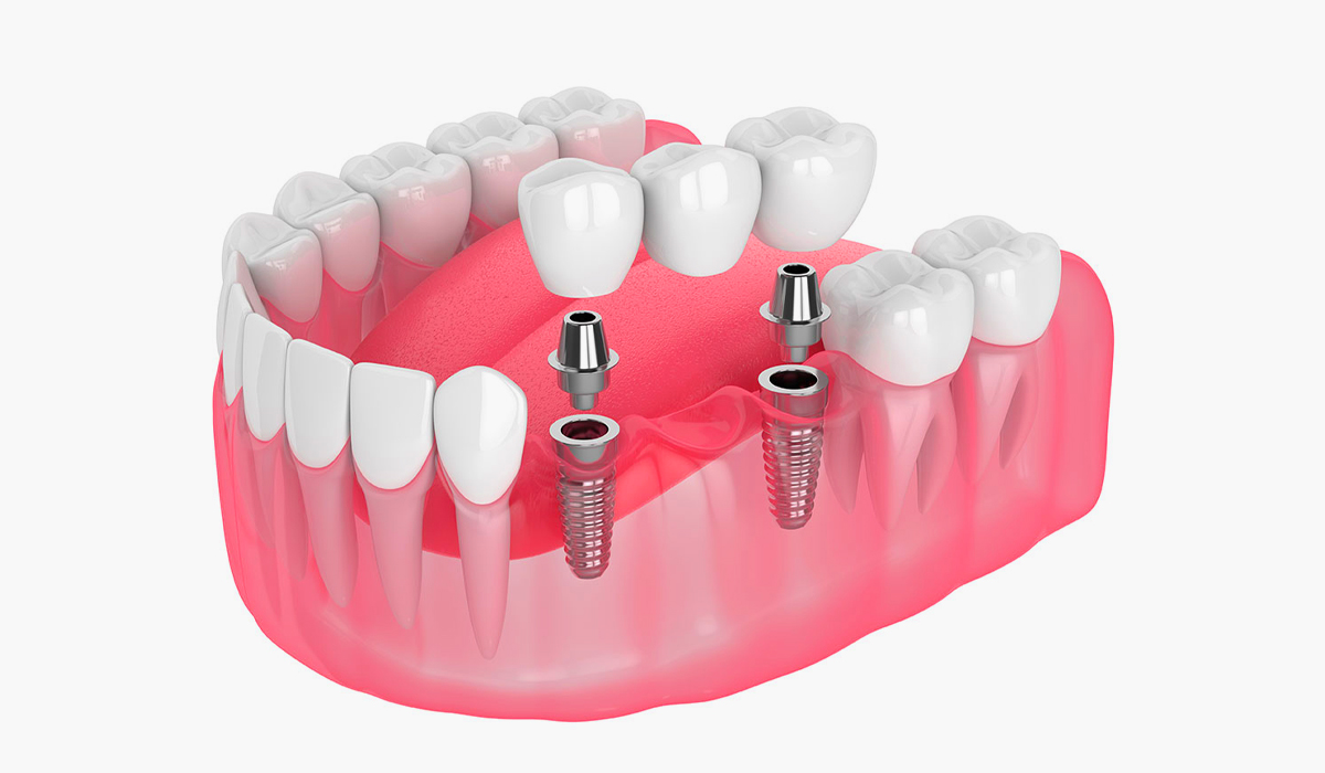 Multiple Dental Implants - dental implant professionals - sydney