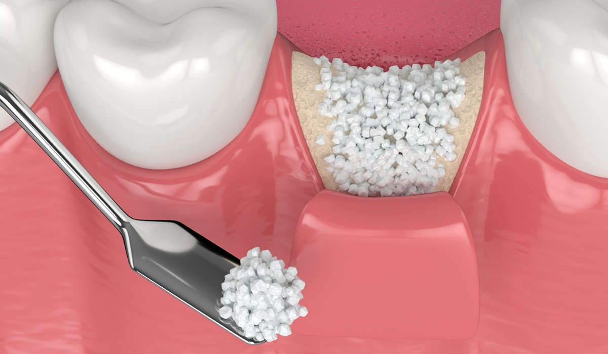 Bone Grafting - dental implant professionals - sydney