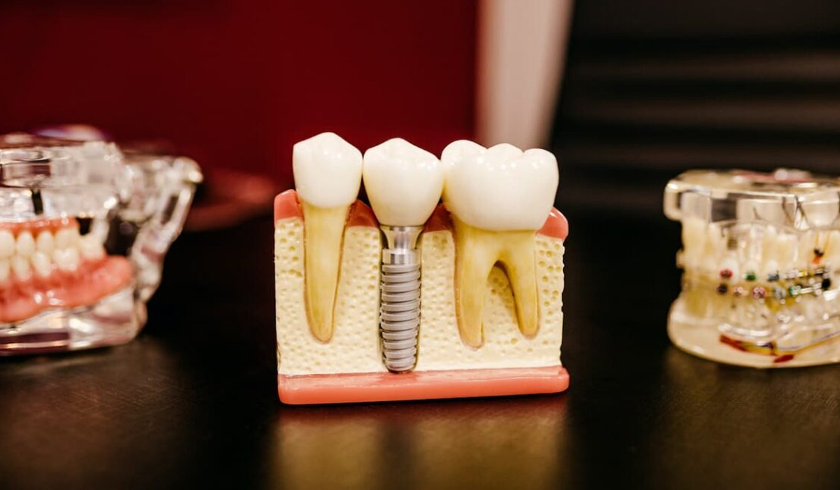 Types of Dental Implants - dental implant professionals - sydney